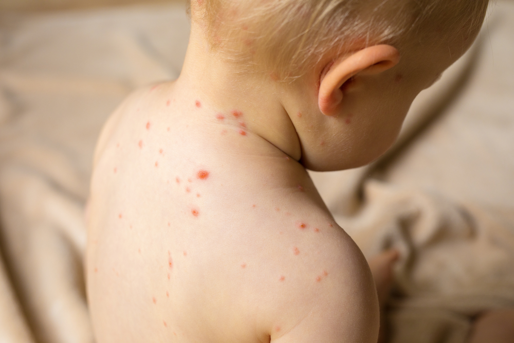 Summertime Chickenpox: Symptoms, Treatment, and Care