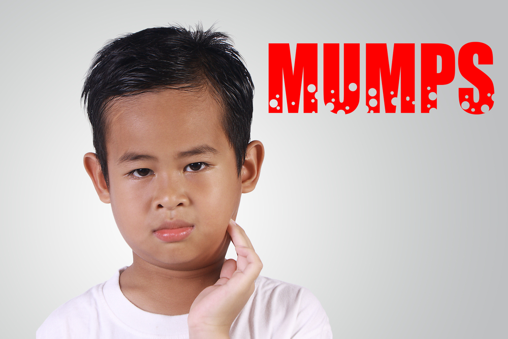 Mumps Outbreaks: What You Need to Know