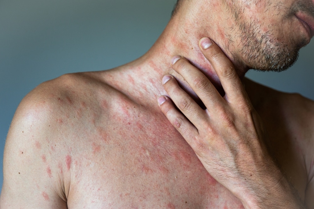 Miles Pharmacy's Guide to Chickenpox Vaccination for Men