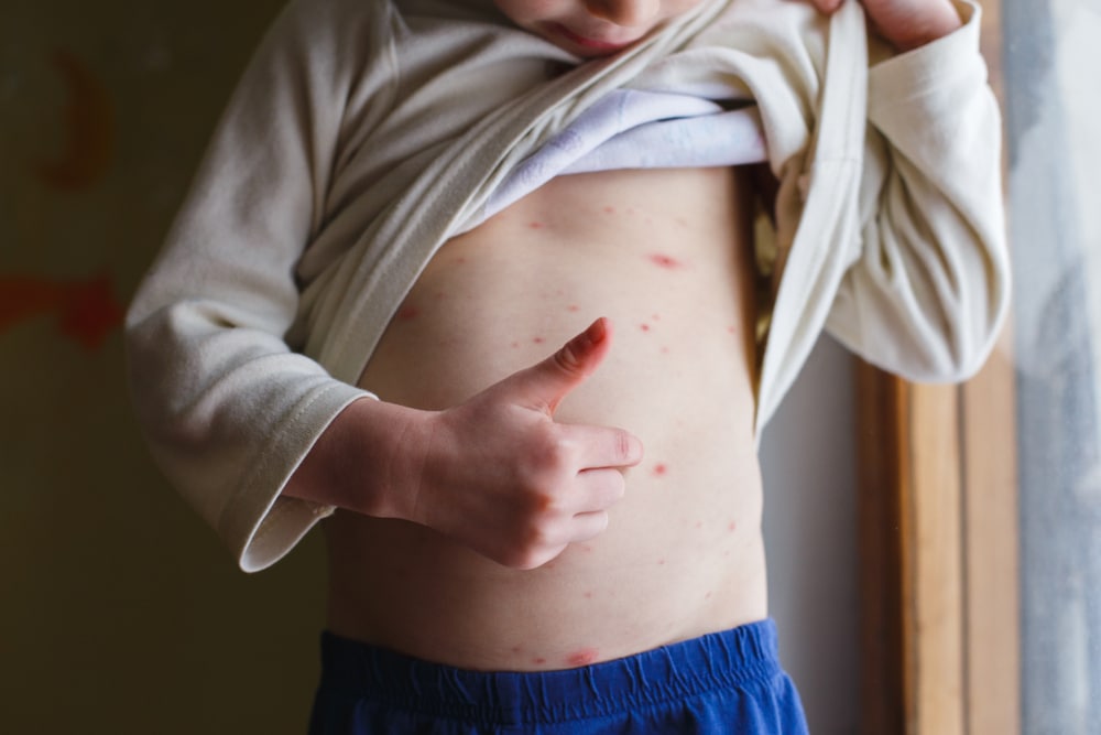 Fact Chickenpox - Miles Pharmacy